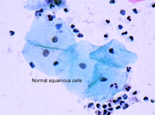 http://commons.wikimedia.org/wiki/File:Squamous_cells.jpg