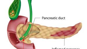 Pancreatitis aguda: causas, síntomas y tratamiento