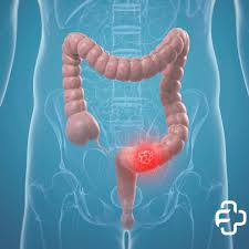 CÀNCER DE CÒLON I RECTE - Farmàcia Capell